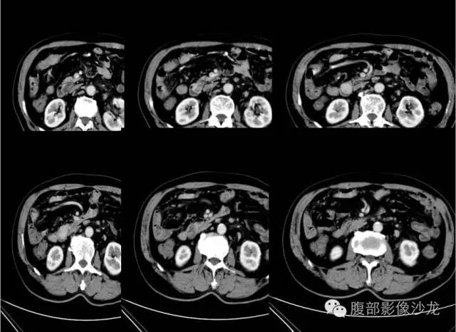 【病例】十二指肠乳头神经内分泌肿瘤1例CT影像表现