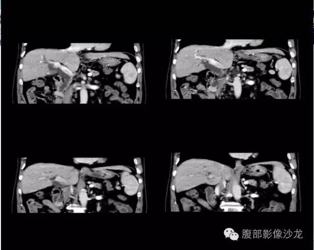 【病例】十二指肠乳头神经内分泌肿瘤1例CT影像表现