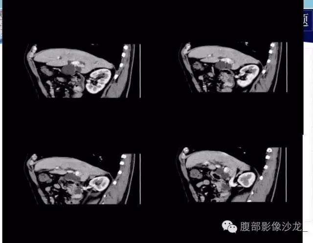 【病例】十二指肠乳头神经内分泌肿瘤1例CT影像表现