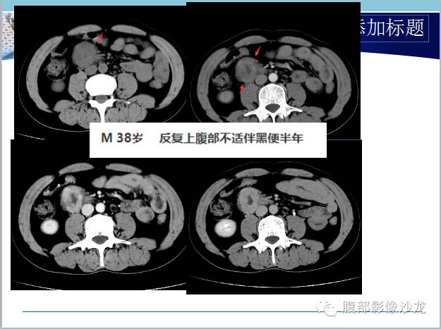 【病例】十二指肠乳头神经内分泌肿瘤1例CT影像表现