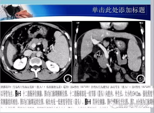 【病例】十二指肠乳头神经内分泌肿瘤1例CT影像表现