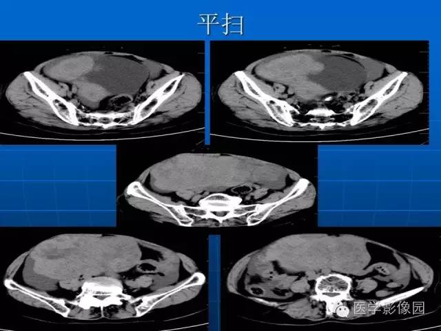 【病例】卵泡膜细胞瘤1例CT影像表现