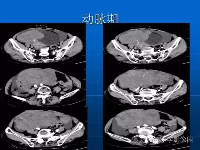 【病例】卵泡膜细胞瘤1例CT影像表现