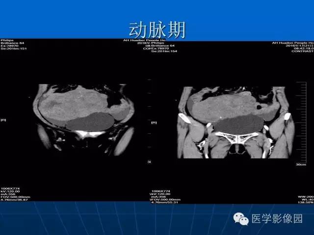 【病例】卵泡膜细胞瘤1例CT影像表现