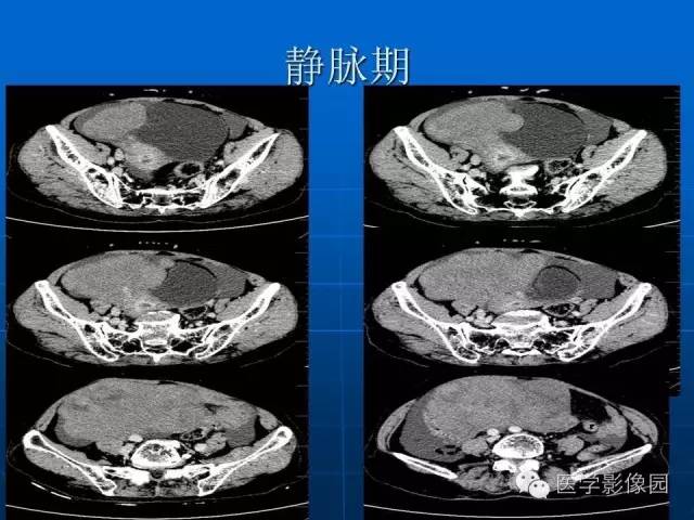 【病例】卵泡膜细胞瘤1例CT影像表现