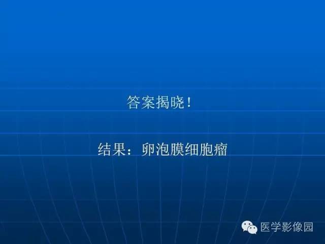 【病例】卵泡膜细胞瘤1例CT影像表现