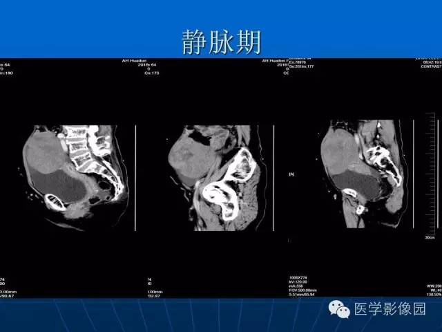 【病例】卵泡膜细胞瘤1例CT影像表现