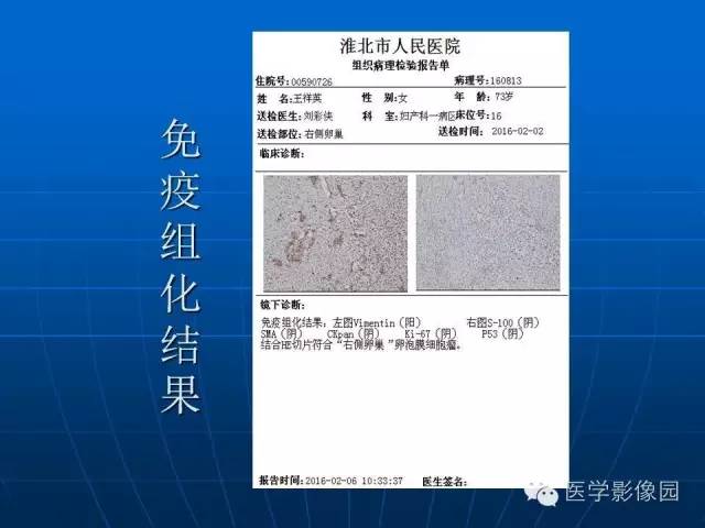 【病例】卵泡膜细胞瘤1例CT影像表现