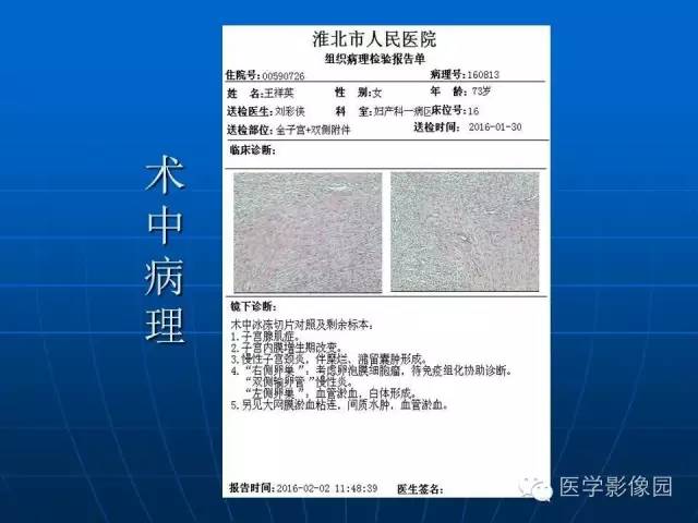 【病例】卵泡膜细胞瘤1例CT影像表现