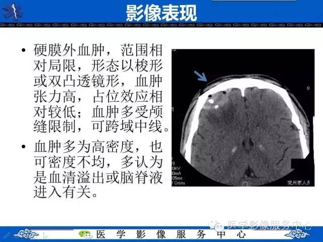 硬膜外血肿与硬膜下血肿的CT鉴别