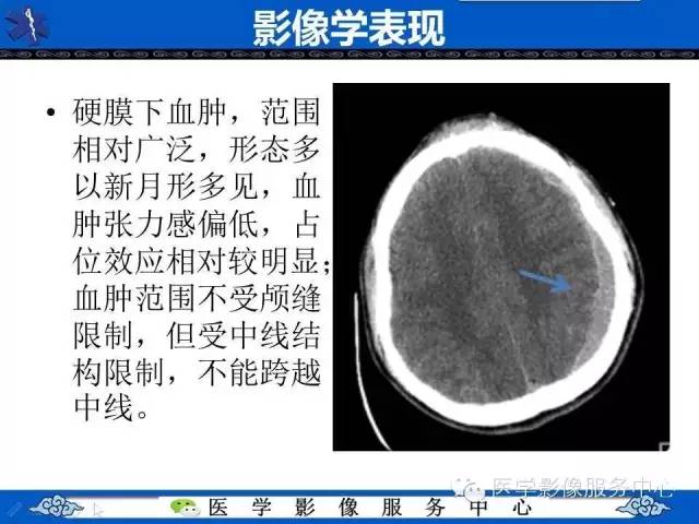 硬膜外血肿与硬膜下血肿的CT鉴别