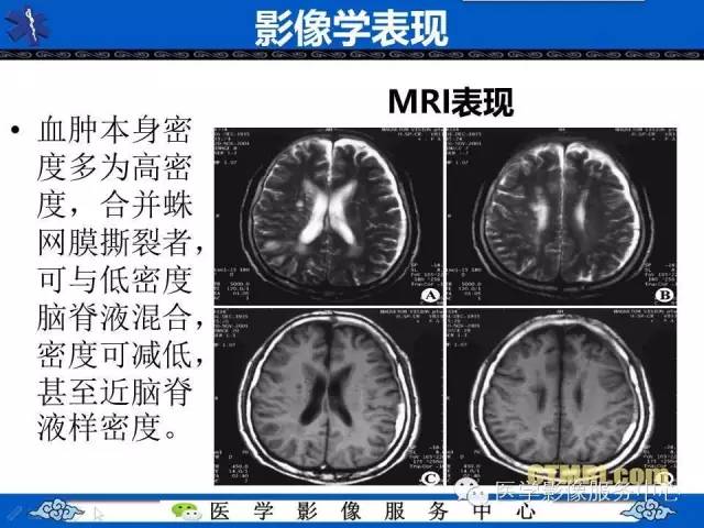 硬膜外血肿与硬膜下血肿的CT鉴别
