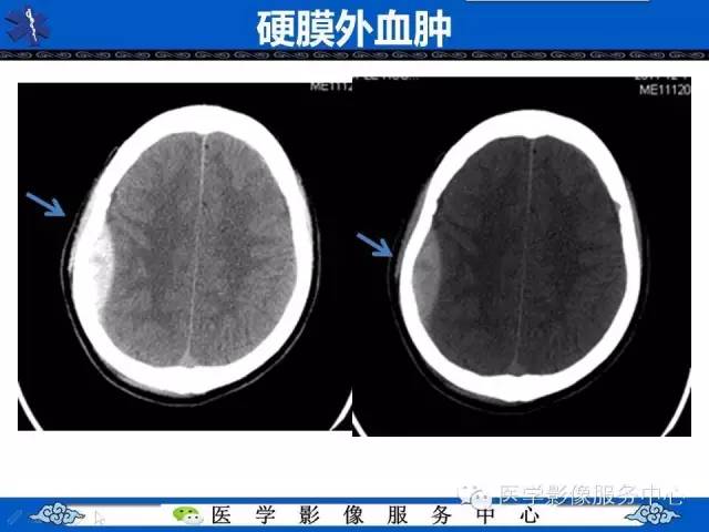 硬膜外血肿与硬膜下血肿的CT鉴别