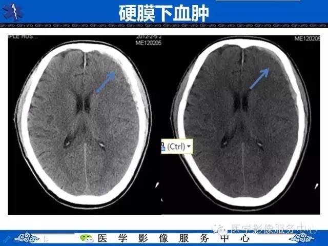 硬膜外血肿与硬膜下血肿的CT鉴别