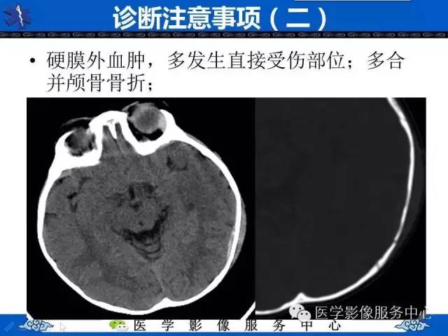 硬膜外血肿与硬膜下血肿的CT鉴别