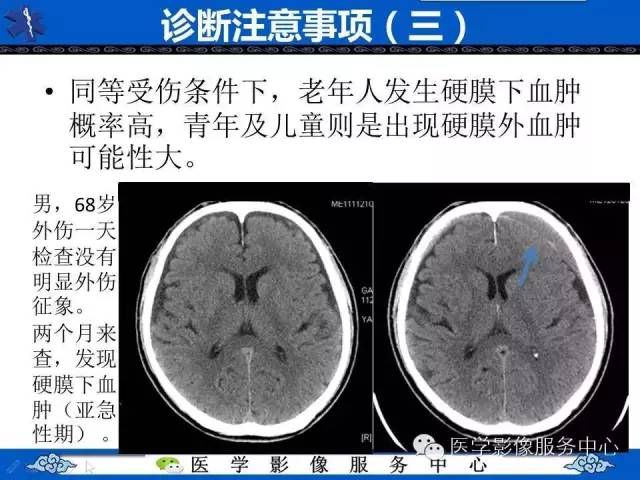 硬膜外血肿与硬膜下血肿的CT鉴别