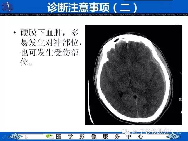 硬膜外血肿与硬膜下血肿的CT鉴别