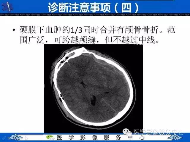 硬膜外血肿与硬膜下血肿的CT鉴别