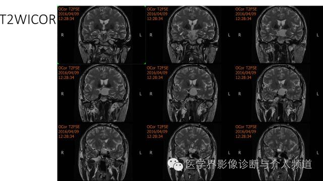 【病例】鞍区Rathke囊肿伴慢性炎症1例MR影像表现 【病例】鞍区Rathke囊肿伴慢性炎症1例MR影像表现