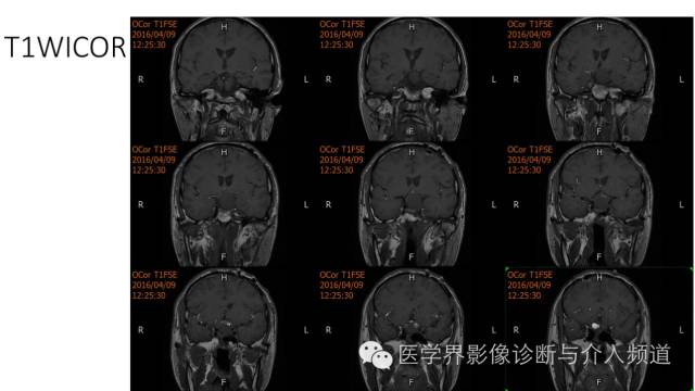 【病例】鞍区Rathke囊肿伴慢性炎症1例MR影像表现