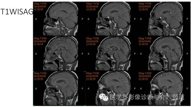 【病例】鞍区Rathke囊肿伴慢性炎症1例MR影像表现 【病例】鞍区Rathke囊肿伴慢性炎症1例MR影像表现