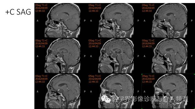 【病例】鞍区Rathke囊肿伴慢性炎症1例MR影像表现 【病例】鞍区Rathke囊肿伴慢性炎症1例MR影像表现