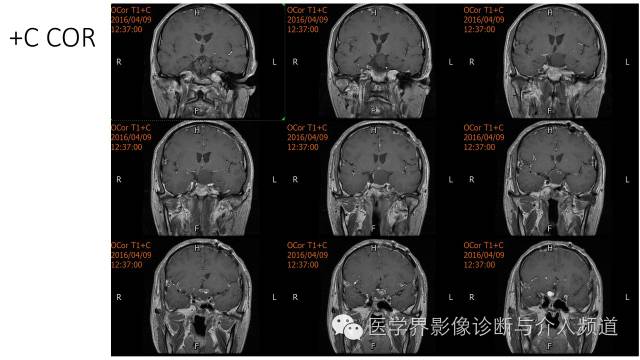 【病例】鞍区Rathke囊肿伴慢性炎症1例MR影像表现 【病例】鞍区Rathke囊肿伴慢性炎症1例MR影像表现