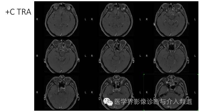 【病例】鞍区Rathke囊肿伴慢性炎症1例MR影像表现 【病例】鞍区Rathke囊肿伴慢性炎症1例MR影像表现