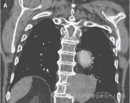 【病例】主动脉瘤侵蚀胸椎椎体1例CT影像表现 【病例】主动脉瘤侵蚀胸椎椎体1例CT影像表现