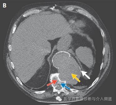 【病例】主动脉瘤侵蚀胸椎椎体1例CT影像表现