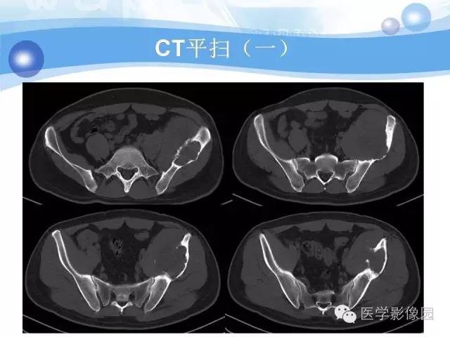 【病例】髂骨血管瘤1例影像表现