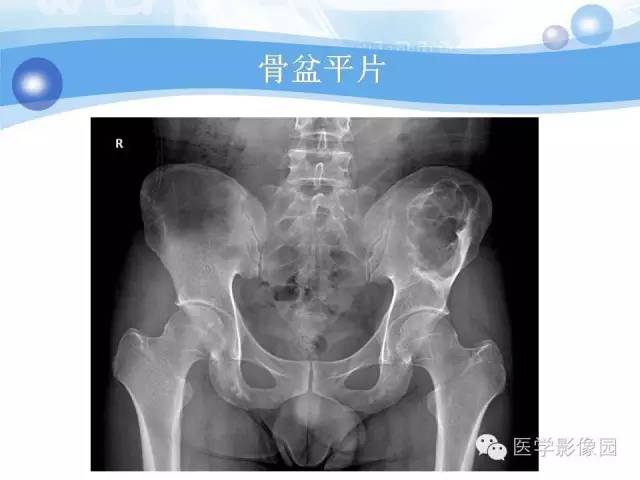 【病例】髂骨血管瘤1例影像表现