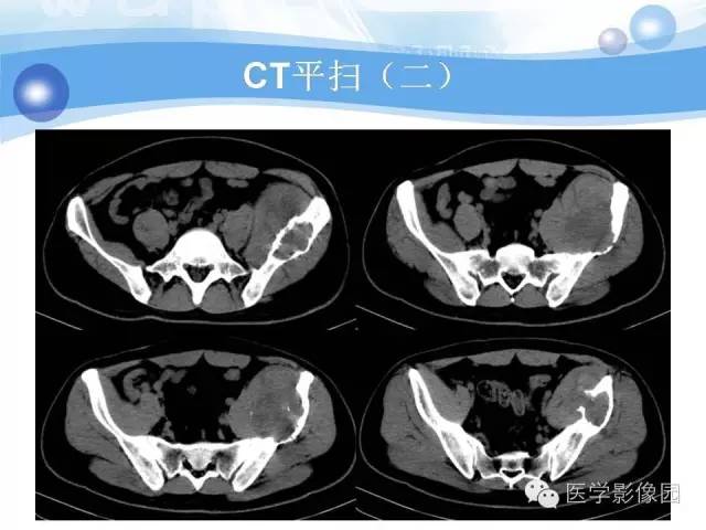 【病例】髂骨血管瘤1例影像表现