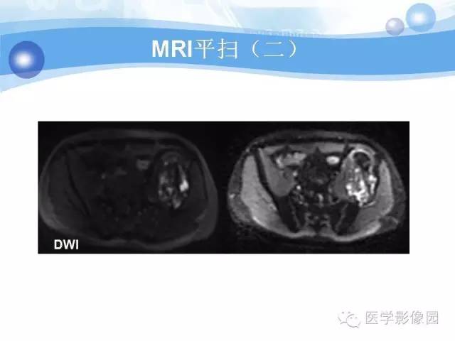 【病例】髂骨血管瘤1例影像表现