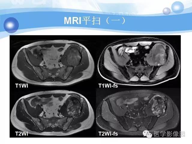 【病例】髂骨血管瘤1例影像表现