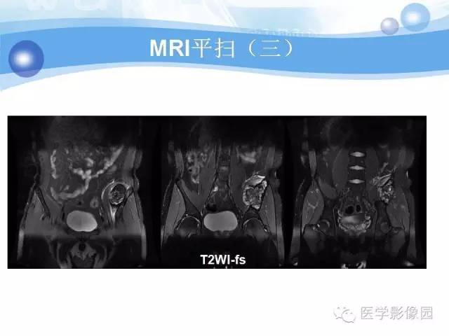 【病例】髂骨血管瘤1例影像表现