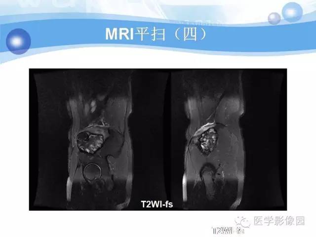 【病例】髂骨血管瘤1例影像表现