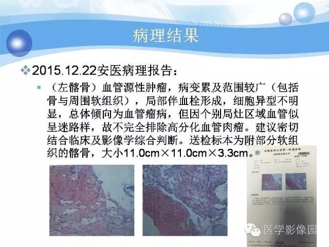 【病例】髂骨血管瘤1例影像表现