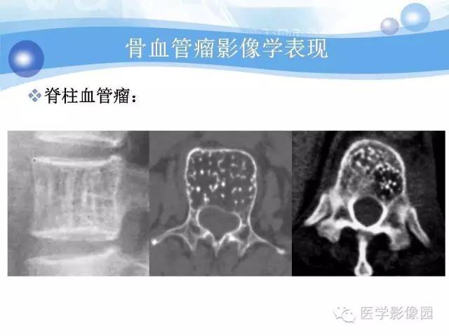 【病例】髂骨血管瘤1例影像表现