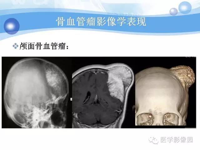 【病例】髂骨血管瘤1例影像表现
