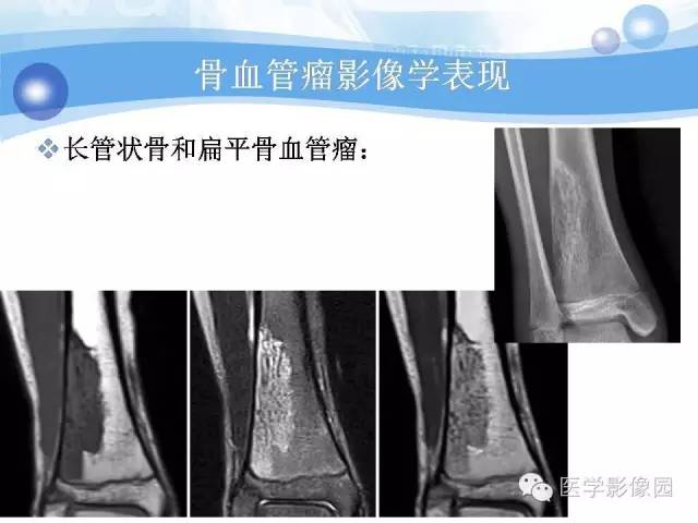 【病例】髂骨血管瘤1例影像表现