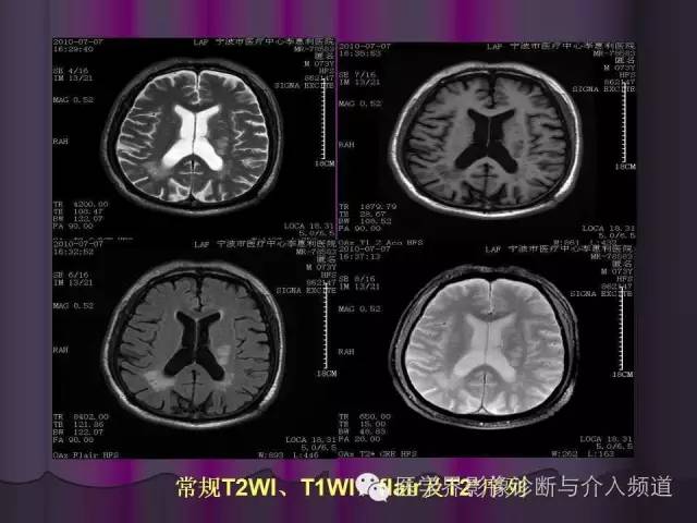 【PPT】联合应用DWI与DTI技术诊断缺血性小卒中及评估其预后