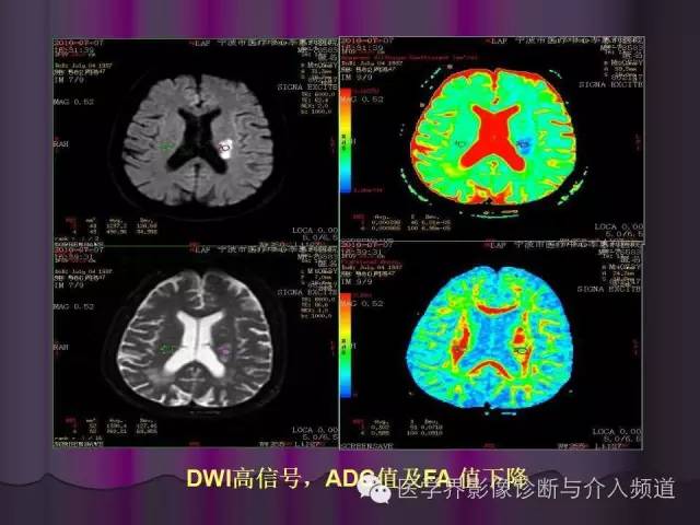 【PPT】联合应用DWI与DTI技术诊断缺血性小卒中及评估其预后