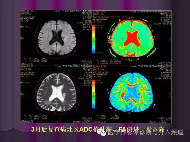 【PPT】联合应用DWI与DTI技术诊断缺血性小卒中及评估其预后