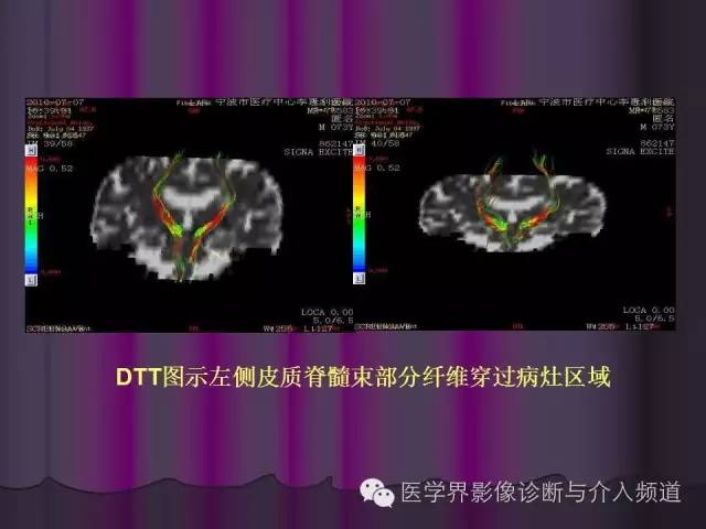 【PPT】联合应用DWI与DTI技术诊断缺血性小卒中及评估其预后