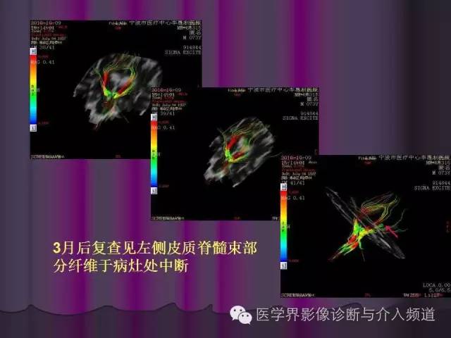 【PPT】联合应用DWI与DTI技术诊断缺血性小卒中及评估其预后