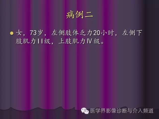【PPT】联合应用DWI与DTI技术诊断缺血性小卒中及评估其预后