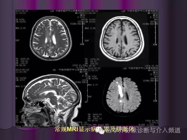 【PPT】联合应用DWI与DTI技术诊断缺血性小卒中及评估其预后