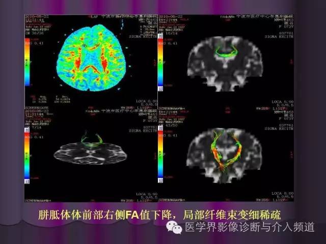 【PPT】联合应用DWI与DTI技术诊断缺血性小卒中及评估其预后