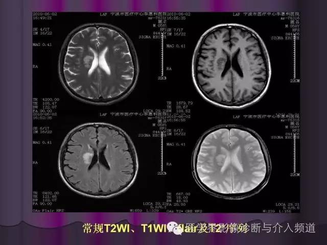 【PPT】联合应用DWI与DTI技术诊断缺血性小卒中及评估其预后